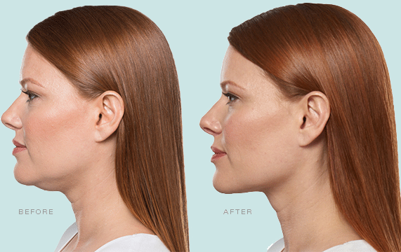 Kybella | Abramson Facial Plastic Surgery Center