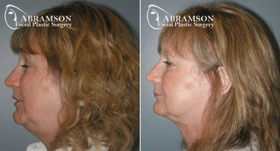Neck lift photos Abramson Facial Plastic Surgery Center | Atlanta, GA