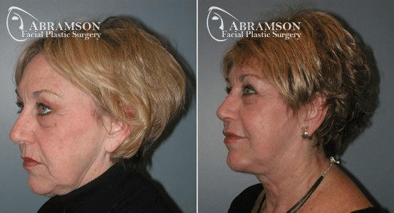 Neck Lift Photos Dr. Peter Abramson | Atlanta, GA | Abramson Facial Plastic Surgery
