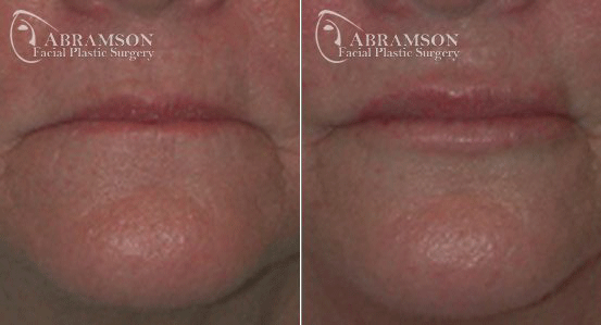 Lip Enhancement Patient 2