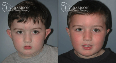 Abramson Facial Plastic Surgery Center | Otoplasty | Ear Surgery