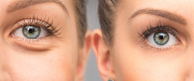 Dr. Peter Abramson | Blepharoplasty Before and After