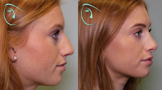 Nose Reduction Rhinoplasty