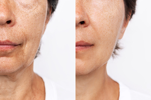 Conservative Approach to facial fillers