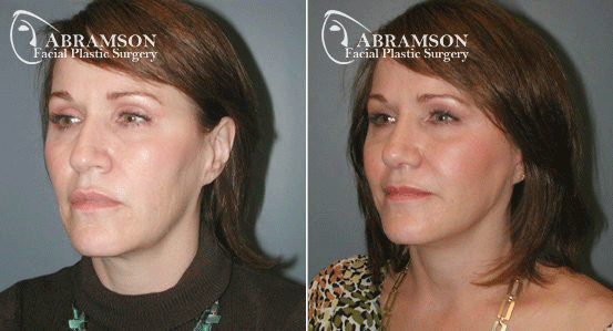 Abramson Facial Plastic Surgery Center | Atlanta, GA
