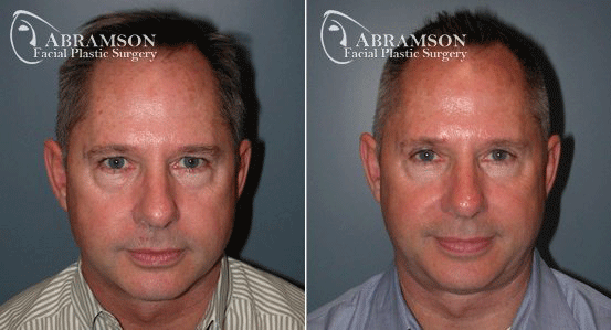 Abramson Facial Plastic Surgery Center | Blepharoplasty