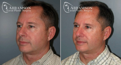 Home | Abramson Facial Plastic Surgery