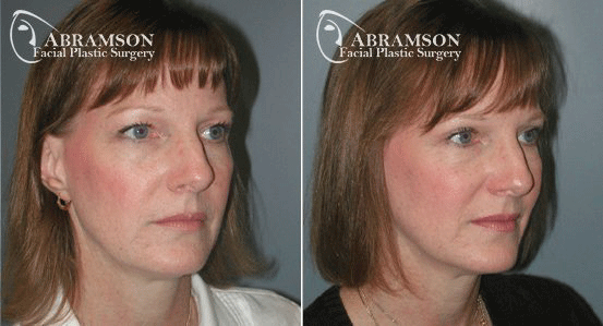 Abramson Facial Plastic Surgery | Blepharoplasty