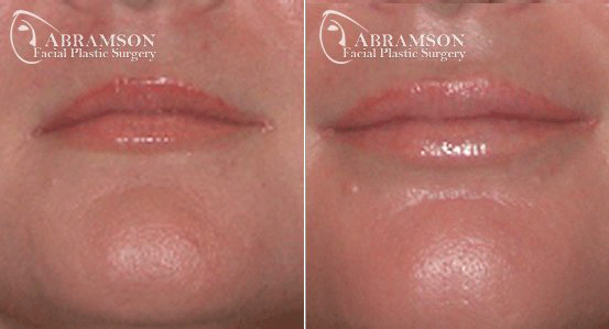 Abramson Facial Plastic Surgery Center | Lip Enhancement