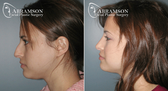 Abramson Facial Plastic Surgery Center | Rhinoplasty