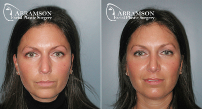 Home | Abramson Facial Plastic Surgery