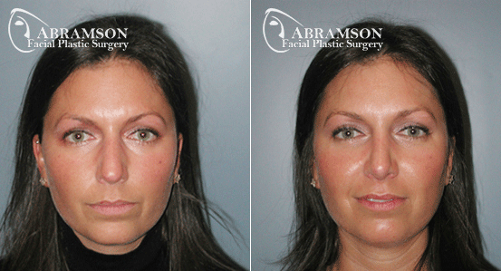Abramson Facial Plastic Surgery Center