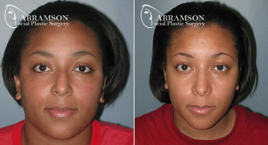 African American rhinoplasty