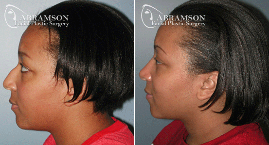 Abramson Facial Plastic Surgery Center | Rhinoplasty