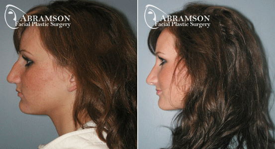 Hump Nose - Abramson Facial Plastic Surgery