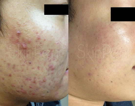 SkinPen II Patient