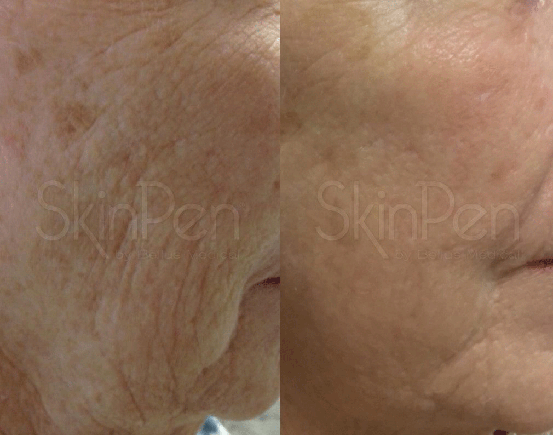 SkinPen Before and After Photos | Abramson Facial Plastic Surgery