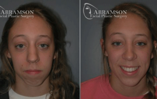 Abramson Facial Plastic Surgery Center | Chin Augmentation