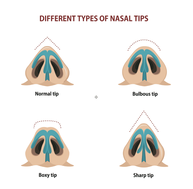 Rhinoplasty for bulbous tip Nose