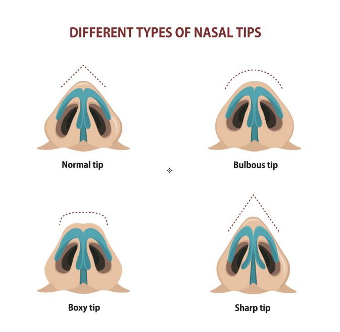 Correcting a Bulbous Tip Nose - Abramson Facial Plastic Surgery