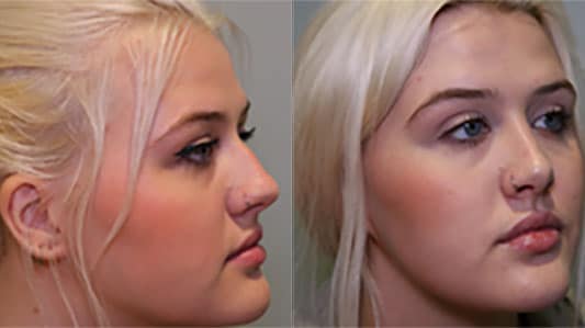 Rhinoplasty before and afteer photo
