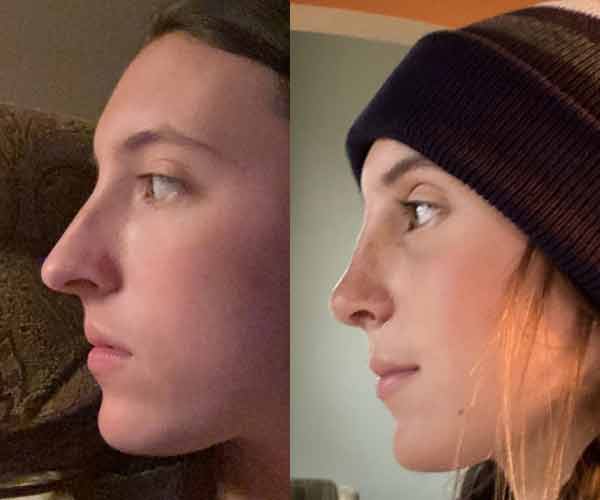 Nose surgery