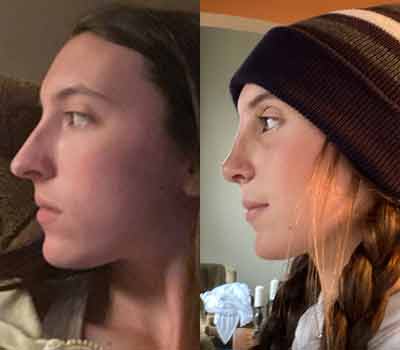 reasons for rhinoplasty