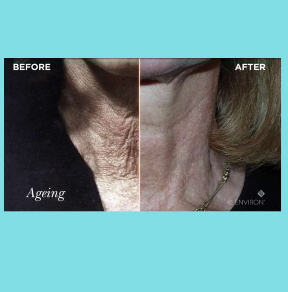The Aging Neck