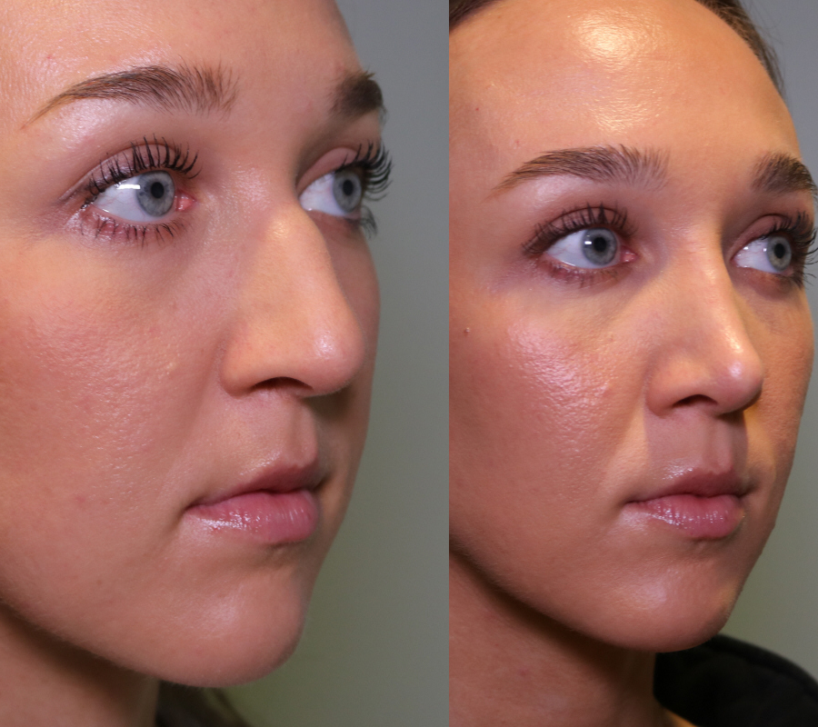 hump nose rhinoplasty