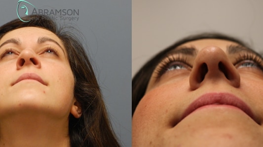 Rhinoplasty before and after