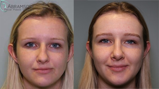 Rhinoplasty before and after photo