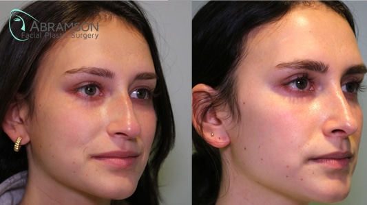 Rhinoplasty before and after photos