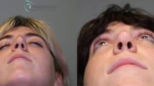 Asymmetric uneven NostrilsRhinoplasty_before and after