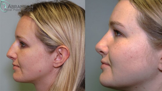 Rhinoplasty before and after photo side view