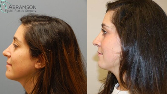 Rhinoplasty before and after