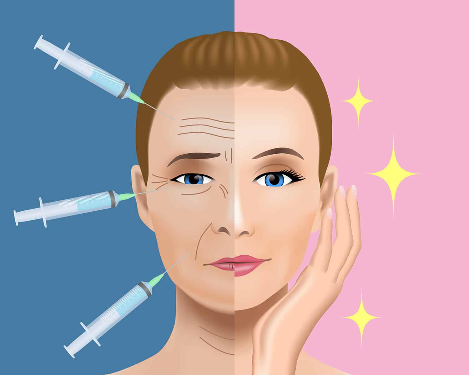 Facelift-Injectables