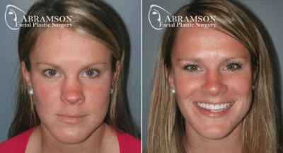 Saddle Nose