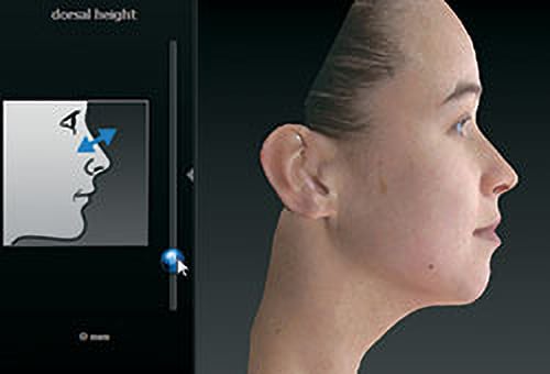 3D dorsal adjustmen increased szt 3D facial computer imaging