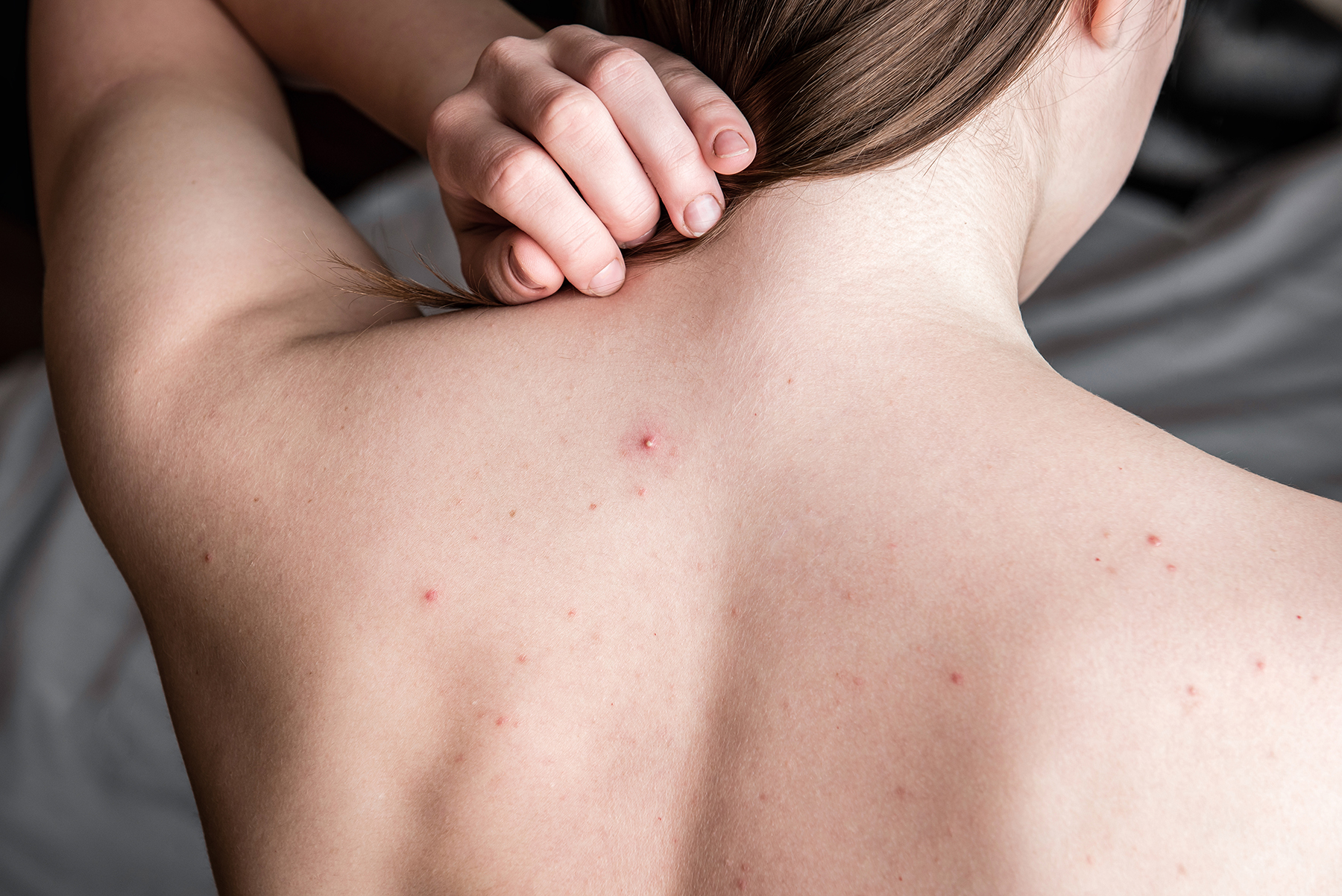 VI Body Peel for acne