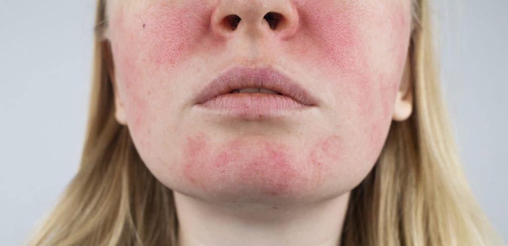 Excel V treatment for Rosacea