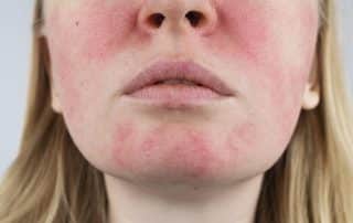 Excel V treatment for Rosacea