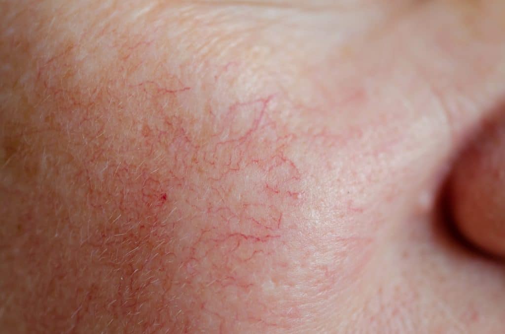 Excel V treats spider veins