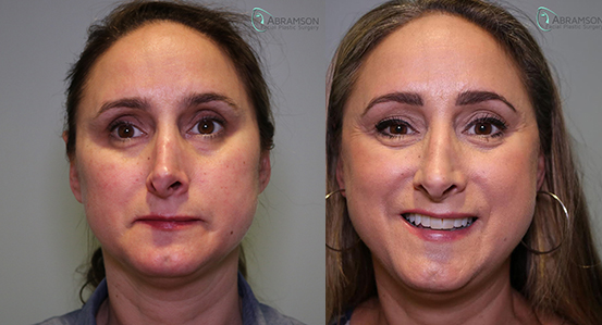 BF Revision Revision Rhinoplasty Before and After