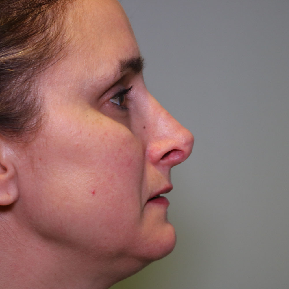 Revision Before side