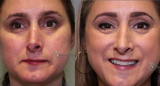 Revision Rhinoplasty Before and After Photo