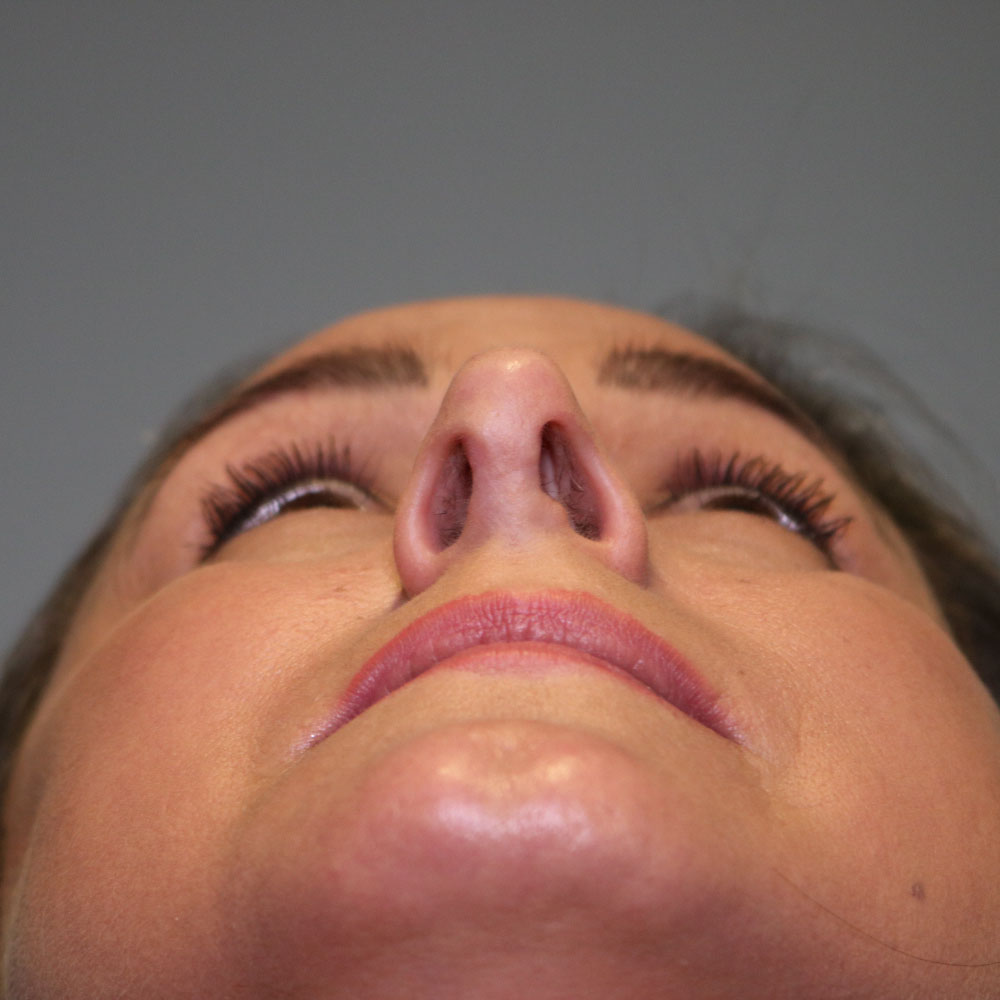 Revision after up the nose copy