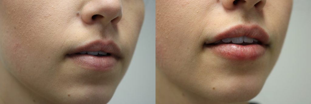 lip filler before and after