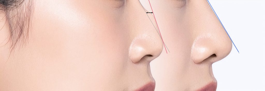 rhinoplasty, Nose Reshaping rhinoplasty, nose reshaping