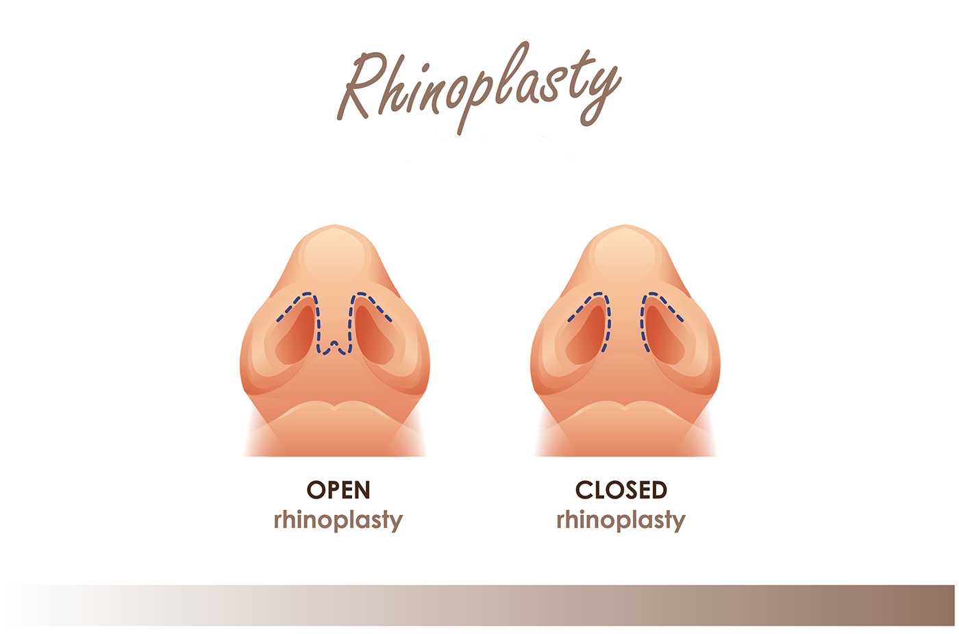 Open vs closed rhinoplasty illustration