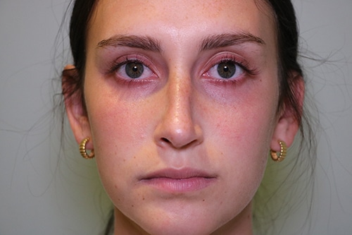 Asymmetric nose before red Asymmetric rhinoplasty before